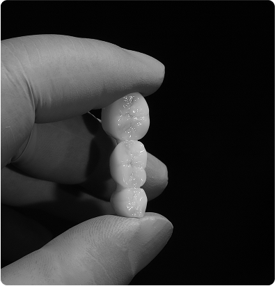 Couronnes et ponts en céramique : restaurer ou remplacer des dents Couronnes et ponts en céramique : restaurer ou remplacer des dents