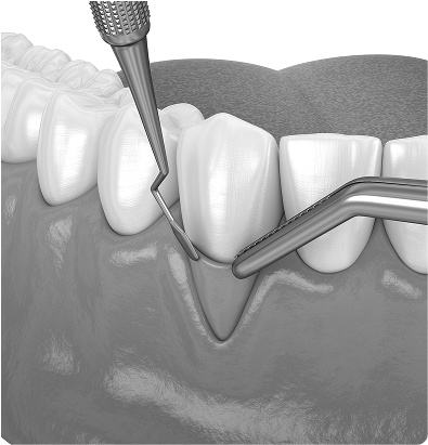 Greffes de gencive Greffes de gencive : protéger les dents, préserver le sourire