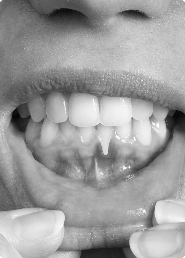 Quand une chirurgie gingivale est-elle indiquée ? Quand une chirurgie gingivale est-elle indiquée ?